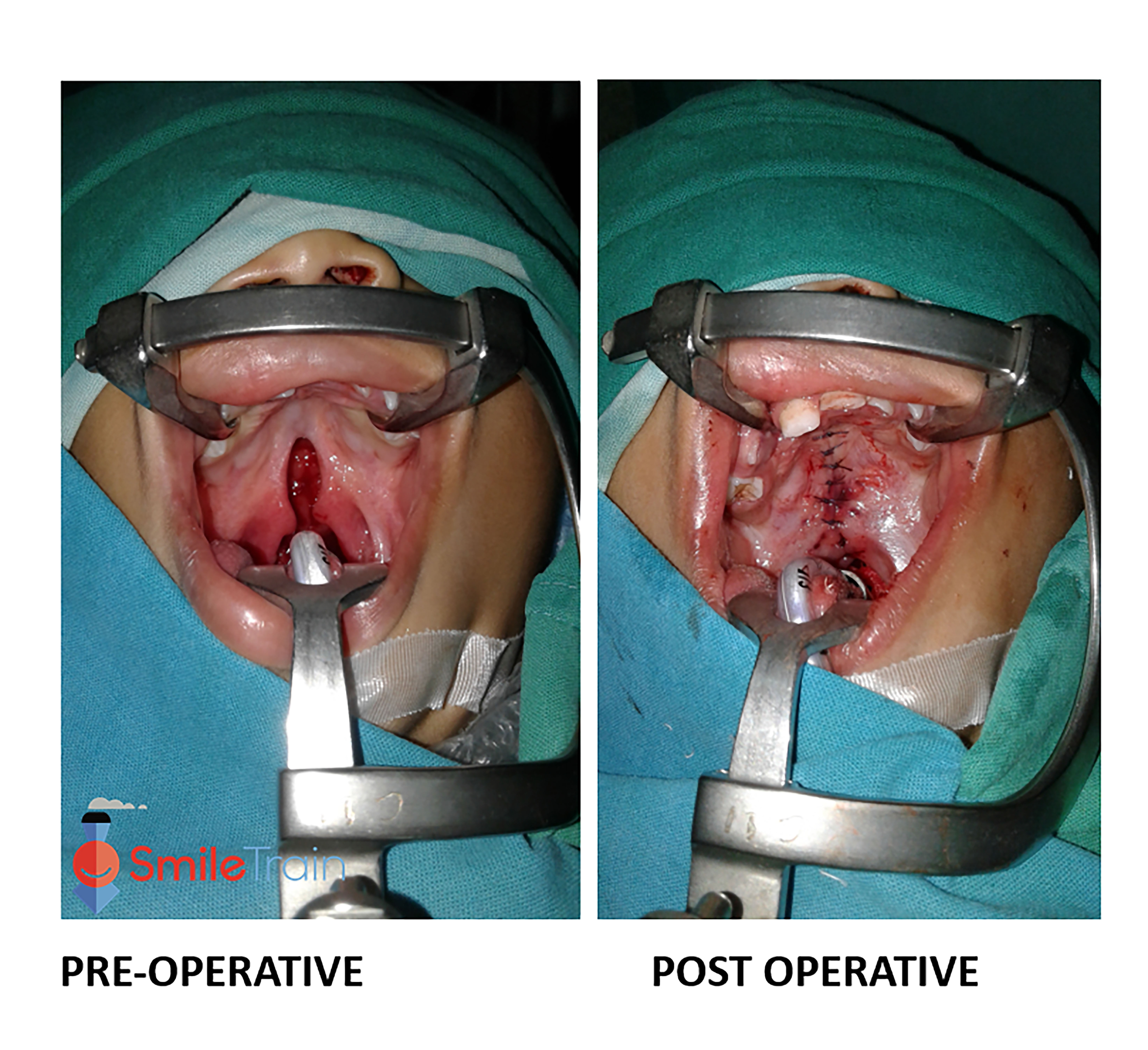 Cleft Palate